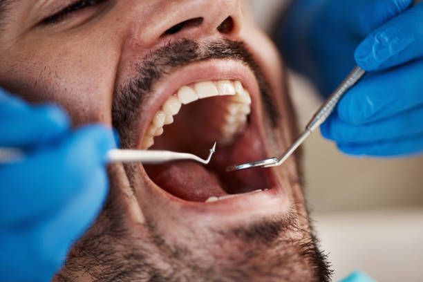 Best Emergency Tooth Extraction in Georgetown, CO