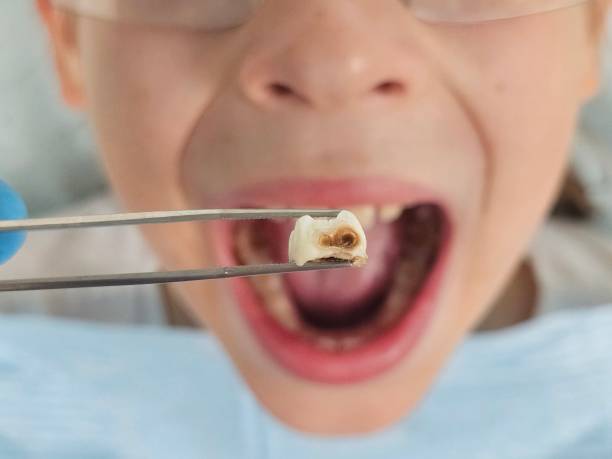 Best Emergency Treatment for Toothache in Georgetown, CO
