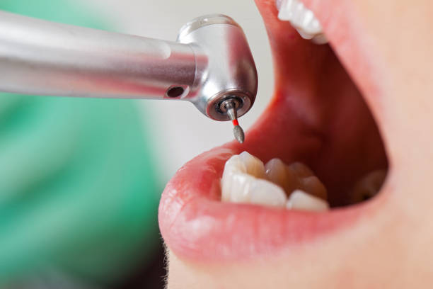 Best Emergency Tooth Extraction in Georgetown, CO